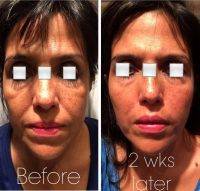 2 Weeks After One Lunch Facelift