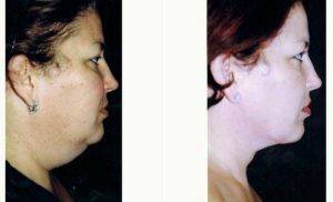 28 Year Old Woman Treated With Facelift Before And After With Dr Robert H. Hunsaker, MD, Miami Plastic Surgeon