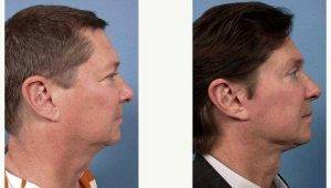 33 Year Old Man Treated With Facelift Before And After By Doctor Frank L. Stile, MD, Las Vegas Plastic Surgeon