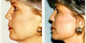 39 Year Old Woman Treated With Facelift By Dr. John L. LeRoy, MD, FACS, Atlanta Plastic Surgeon