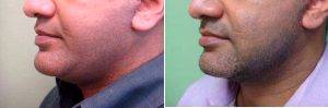 43 Year Old Man Treated With Facelift By Doctor Peter Chang, MD, Houston Plastic Surgeon