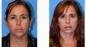 43 Year Old Woman Treated With Facelift Before And After By Dr Onelio Garcia Jr, MD, FACS, Miami Plastic Surgeon