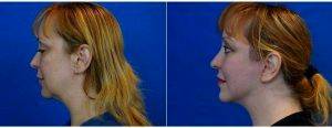 44 Year Old Woman Treated With Facelift Before And After With Dr Christopher Khorsandi, MD, Las Vegas Plastic Surgeon