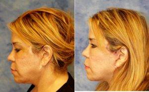 45 Year Old Woman Treated With Facelift Before And After With Dr Wendell Perry, MD, Miami Plastic Surgeon