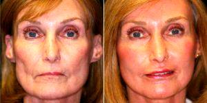 45 Year Old Woman Treated With Facelift By Dr Raghu Athre, MD, Houston Facial Plastic Surgeon