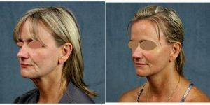 46 Year Old Woman Treated With Facelift With Doctor James F. Boynton, MD, FACS, Houston Plastic Surgeon