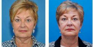 47 Year Old Woman Treated With Facelift By Dr. Mark Beaty, MD, Atlanta Facial Plastic Surgeon