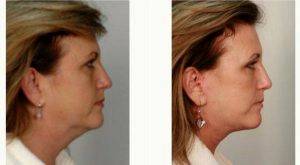 48 Year Old Female Facelift By Dr. R. Scott Yarish, MD, Houston Plastic Surgeon