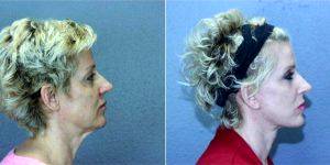48 Year Old Woman Treated With Facelift Before And After By Doctor John A. Standefer Jr., MD, FACS, Dallas Facial Plastic Surgeon