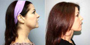 48 Year Old Woman Treated With Facelift Before And After By Dr. Marcelo Ghersi, MD, Miami Plastic Surgeon