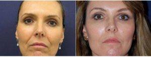 48 Year Old Woman Treated With Facelift Before And After By Dr. Yannis Alexandrides, MD, London Plastic Surgeon