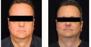 49 Year Old Man Treated With MACS Face Lift With Dr. Ned Snyder, IV, MD, Austin Plastic Surgeon