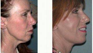 49 Year Old Woman Treated With Facelift Before And After By Dr. Jeff Angobaldo, MD, Dallas Plastic Surgeon