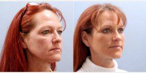 49 Year Old Woman Treated With Facelift With Dr. Bruce K. Smith, MD, Houston Plastic Surgeon