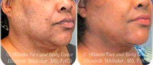 50 Year Old Woman Treated With Facelift By Doctor Elizabeth Whitaker, MD, FACS, Atlanta Facial Plastic Surgeon