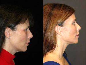 51 Year Old Female Before And After By Dr. Goesel Anson, MD, FACS, Las Vegas Plastic Surgeon