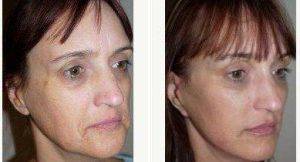 51 Year Old Woman Treated With Facelift Before And After With Dr. Hayley Brown, MD, FACS, Las Vegas Plastic Surgeon