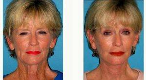 52 Year Old Woman Treated With Brow Lift With Dr William McClure, MD, San Francisco Plastic Surgeon