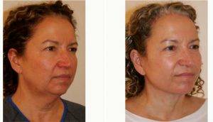 52 Year Old Woman Treated With Facelift By Doctor Dino R. Elyassnia, MD, San Francisco Plastic Surgeon