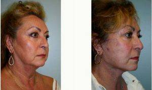 52 Year Old Woman Treated With Facelift By Dr Leo Lapuerta, MD, Houston Plastic Surgeon