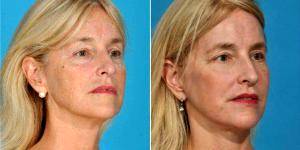 53 Year Old Woman Treated With Facelift Before And After By Dr. Bradley A. Hubbard, MD, Dallas Plastic Surgeon