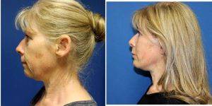 54 Year Old Woman Treated With Facelift, Chin Implant And Eyelid Surgery Before And After With Dr Damian Marucci, MBBS, PhD, FRACS, Sydney Plastic Surgeon