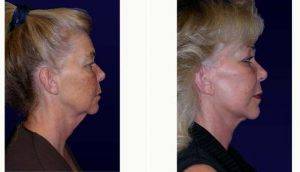 55 Year Old Woman Treated With Facelift By Dr. William H. Gorman, MD, Austin Plastic Surgeon