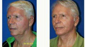 56 Year Old Man Treated With Facelift Before And After By Dr Sam Gershenbaum, DO, Miami Plastic Surgeon