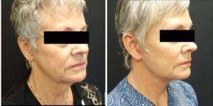 57 Year Old Woman Treated With Face And Neck Lift With Facial Fat Grafting. With Dr Johnny Franco, MD, FACS, Austin Plastic Surgeon