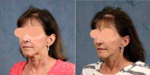 57 Year Old Woman Treated With Facelift And Neck Lift With Dr James F. Boynton, MD, FACS, Houston Plastic Surgeon