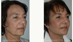 57 Year Old Woman Treated With Facelift Before And After By Doctor Andres Bustillo, MD, FACS, Miami Facial Plastic Surgeon