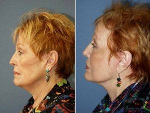 57 Year Old Woman Treated With Facelift By Doctor Bradford S. Patt, MD, Houston Facial Plastic Surgeon