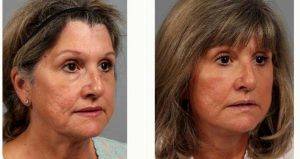 57 Year Old Woman Treated With Facelift By Dr Gregory J. Mackay, MD, Atlanta Plastic Surgeon