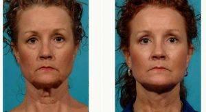59 Year Old Woman Treated With Facelift Before And After By Doctor P. Craig Hobar, MD, Dallas Plastic Surgeon