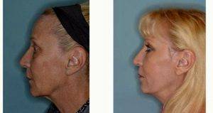 59 Year Old Woman Treated With Facelift Before And After By Dr. Anthony Bared, MD, FACS, Miami Facial Plastic Surgeon