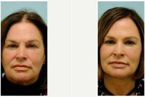 59 Year Old Woman Treated With Facelift Before And After By Dr. Sam Lam, MD, FACS, Dallas Facial Plastic Surgeon