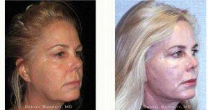59 Year Old Woman Treated With Facelift Before And After With Doctor Daniel Barrett, MD, Beverly Hills Plastic Surgeon