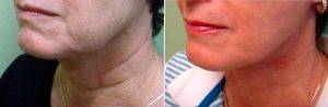 59 Year Old Woman Treated With Facelift By Doctor Peter Chang, MD, Houston Plastic Surgeon