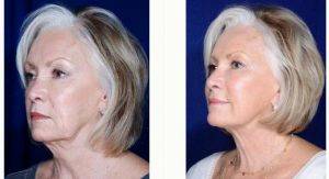 59 Year Old Woman Treated With Facelift By Dr. Stephen J. Ronan, MD, FACS, San Francisco Plastic Surgeon