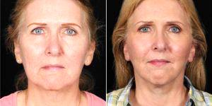 60 Year Old Woman Treated With Facelift Before And After With Dr. Michael R. Lee, MD, Dallas Plastic Surgeon