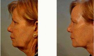 60 Year Old Woman Treated With Facelift By Doctor Burke Robinson, MD, FACS, Atlanta Facial Plastic Surgeon