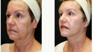 61 Year Old Woman Treated With Facelift By Doctor Young R. Cho, MD, PhD, Houston Plastic Surgeon