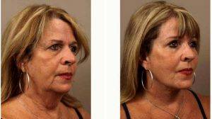 62 Year Old Woman Treated With Facelift And Eyelid Surgery By Dr Louis W. Apostolakis, MD, Austin Facial Plastic Surgeon