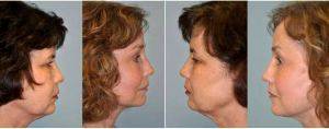 62 Year Old Woman Treated With Facelift With Dr Eugene L. Alford, MD, Houston Facial Plastic Surgeon