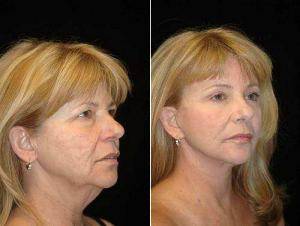 63 Year Old Female Before And After By Dr. Goesel Anson, MD, FACS, Las Vegas Plastic Surgeon