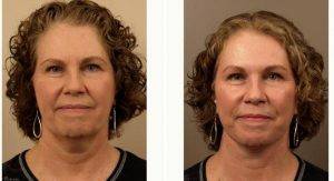 63 Year Old Woman Treated With Facelift, Restylane To Creases Between The Eyebrows And Dysport With Doctor Louis W. Apostolakis, MD, Austin Facial Plastic Surgeon