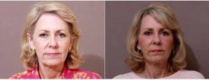 63 Year Old Woman Treated With Facelift With Dr Clayton L. Moliver, MD, Houston Plastic Surgeon