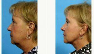 64 Year Old Woman Treated With Facelift Before And After With Doctor Michael A. Bogdan, MD, FACS, Dallas Plastic Surgeon