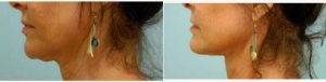 64 Year Old Woman Treated With Facelift Before And After With Dr Sam Lam, MD, FACS, Dallas Facial Plastic Surgeon