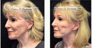 65 Year Old Woman Treated With Facelift Before And After With Doctor Dallas Buchanan, MD, Spokane Plastic Surgeon
